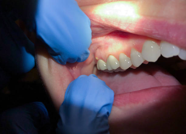 Best After-Hours Dental Trauma Care in North Wilkesboro, NC