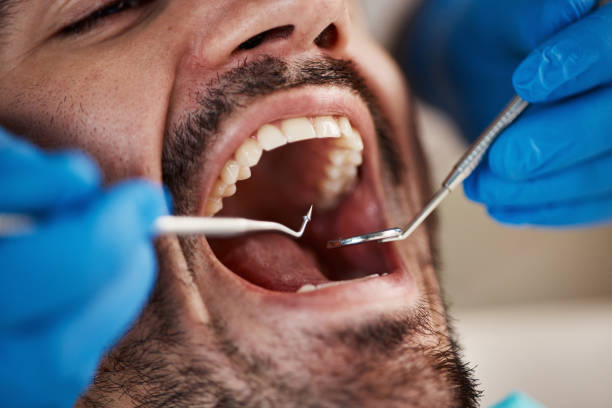 Best Emergency Tooth Extraction in North Wilkesboro, NC